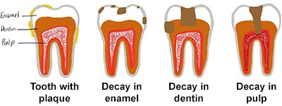 bitty bites cavity prevention tooth illustration