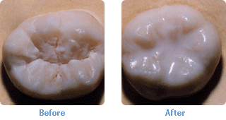 bitty bites sealants on teeth